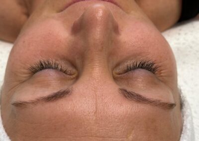 Před ošetřením Rejulift